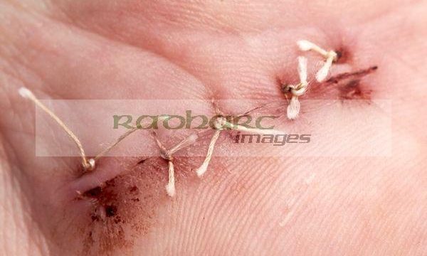 dissolvable stitches in a hand surgical wound to correct carpal tunnel syndrome